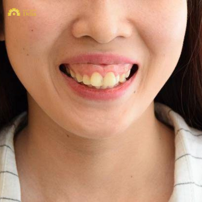 Khi nào cần áp dụng mài xương ổ răng? 
