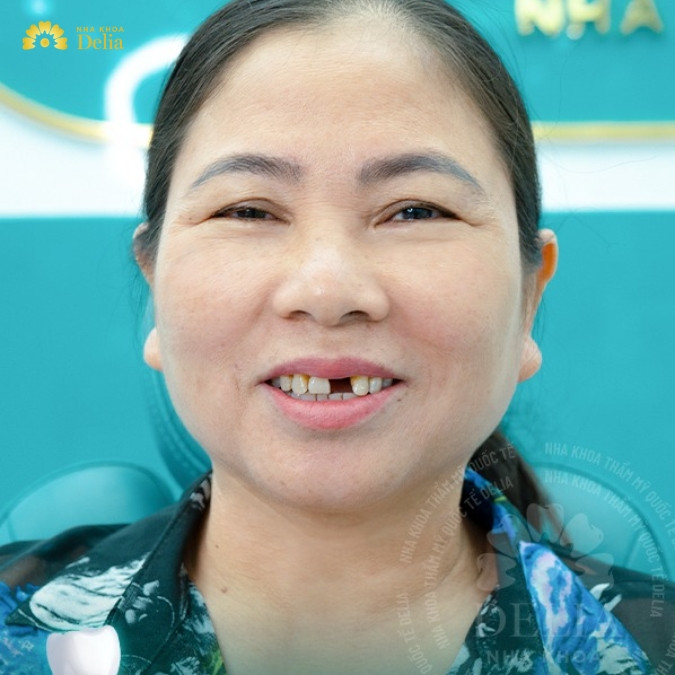 Hành trình tìm lại nụ cười hạnh phúc của cô Vũ Thị Phương tại nha khoa Delia