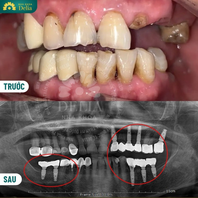 Một số nguyên nhân gây mất răng phổ biến 