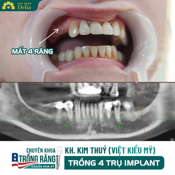 Một số nguyên nhân gây mất răng phổ biến 