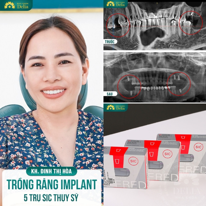 Phương pháp khắc phục lệch mặt hiệu quả là phục hồi răng mất 
