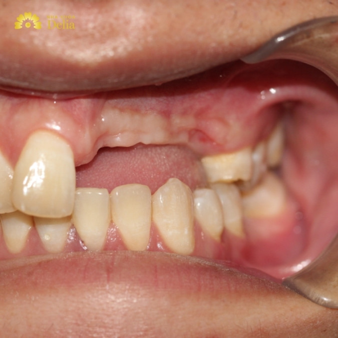 Mất răng số 4 có sao không? Có cần trồng lại không? 
