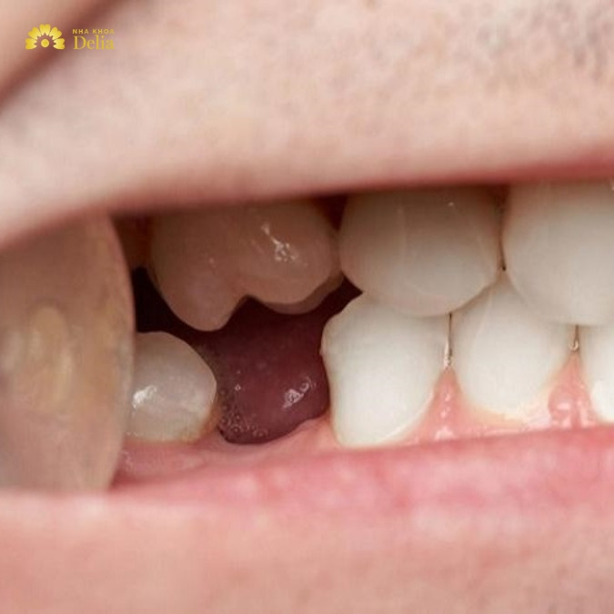 Mất răng số 6 có thể gây ra những ảnh hưởng nghiêm trọng nào? 