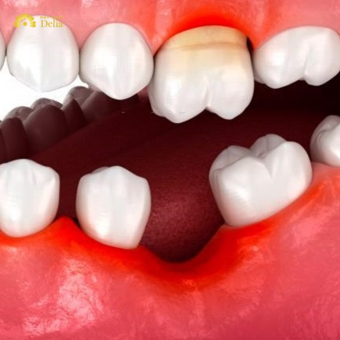Một số nguyên nhân có thể khiến răng số 6 bị tổn thương