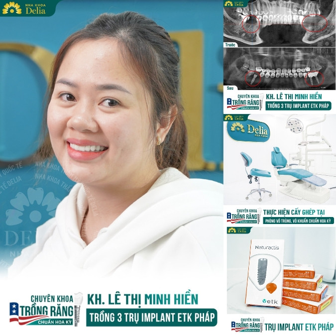 Phương pháp nào phục hồi răng số 6 hiệu quả nhất? 