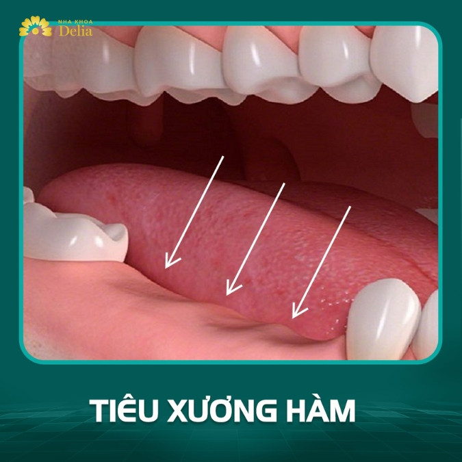 Mất răng số 7 có thể gây ra các biến chứng nghiêm trọng nào?