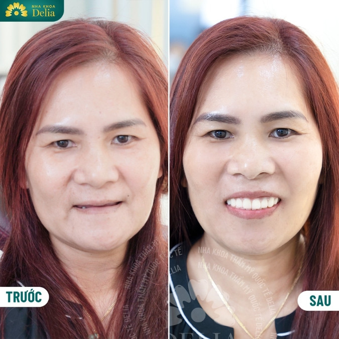 Hành trình giải cứu mất răng toàn hàm của khách hàng Tạ Thị Xiếu 