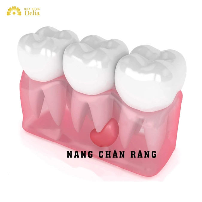 Tìm hiểu về nang xương răng