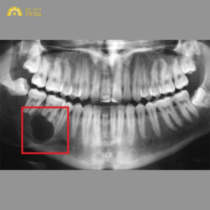 Nang xương hàm có mấy loại? 