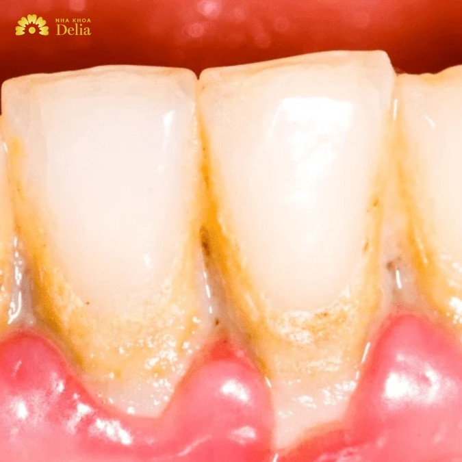 Nang xương hàm có mấy loại? 