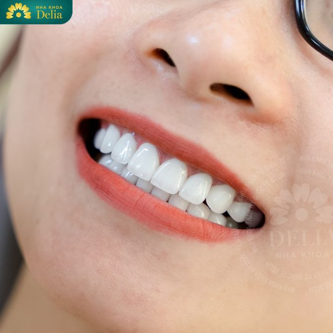 Bọc răng sứ thẩm mỹ cải thiện răng cửa quặp