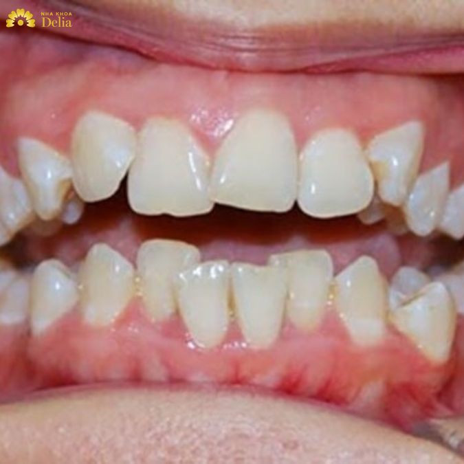 Tính thẩm mỹ bị ảnh hưởng nghiêm trọng