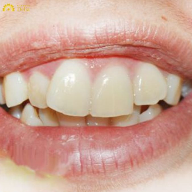 Tăng nguy cơ mắc các bệnh lý về răng miệng