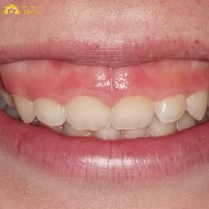 Ngoài những lý do trên, thói quen không tốt cũng là một yếu tố khiến răng của bạn ngắn lại