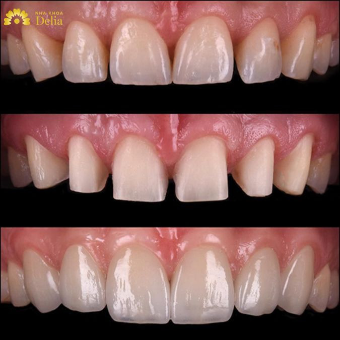 Xét trên góc độ nha khoa, những người có răng cửa nhỏ không đẹp