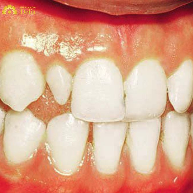 Răng cửa nhọn nhỏ