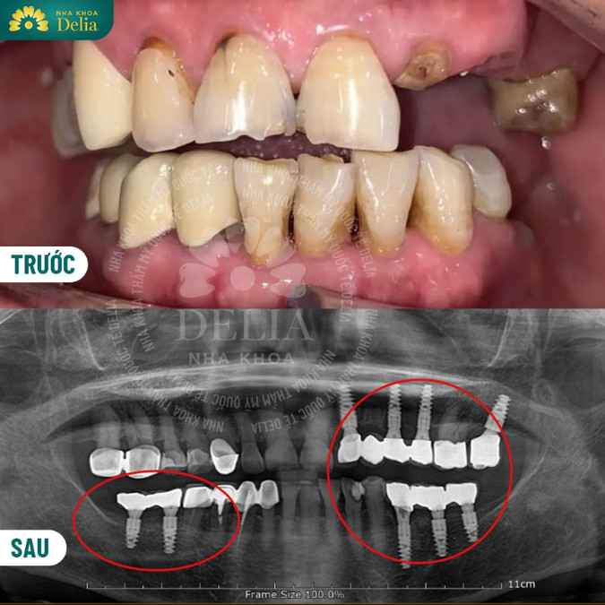 Giải đáp: Răng mất 5 năm có trồng được Implant không