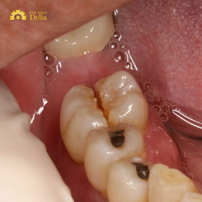 Răng số 6 bị sâu có nên nhổ không? Lời khuyên từ chuyên gia