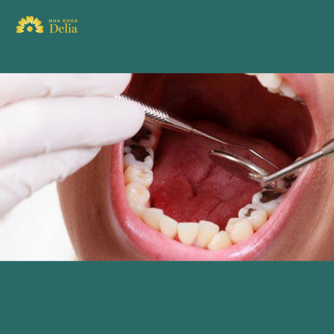 Răng số 6 bị sâu có nên nhổ không?