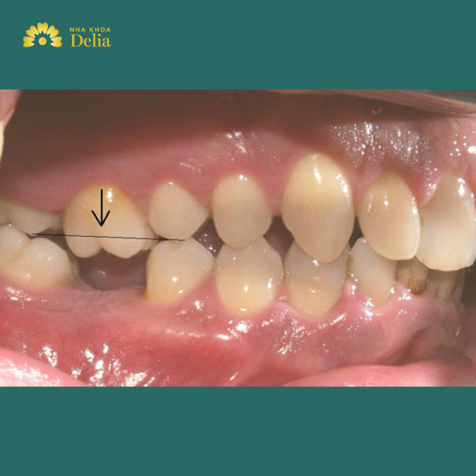 Tầm quan trọng của răng số 6 trong hàm răng