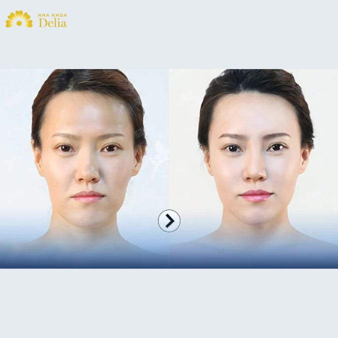 Hình ảnh trước và sau khi tiêm rãnh cười 