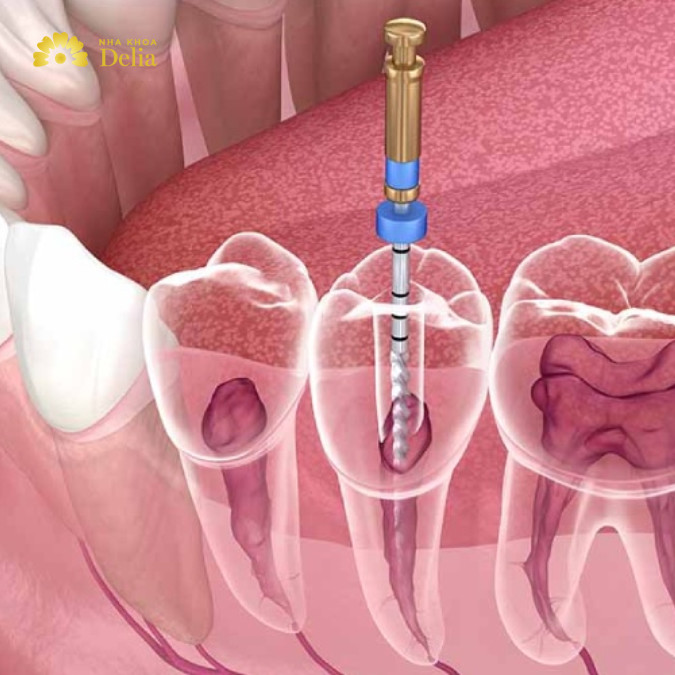 sâu răng có chữa được không