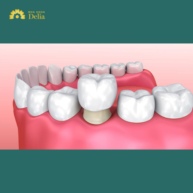 Điều trị sâu răng bằng phương pháp bọc răng sứ