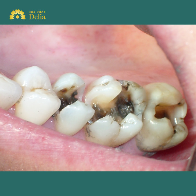 Sâu răng có lây không? Giải đáp những hiểu lầm và cách phòng tránh