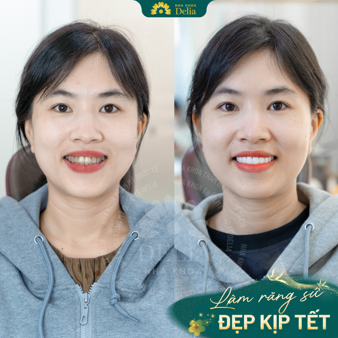 Bọc răng sứ điều trị răng sâu