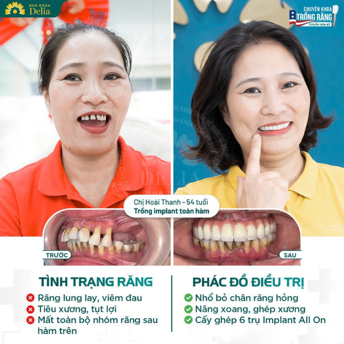 Răng sâu nặng cần nhổ bỏ sau đó trồng Implant