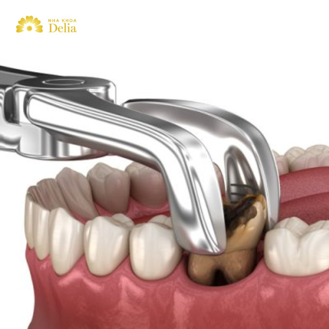 Răng sâu nghiêm trọng cần nhổ và phục hình với răng giả