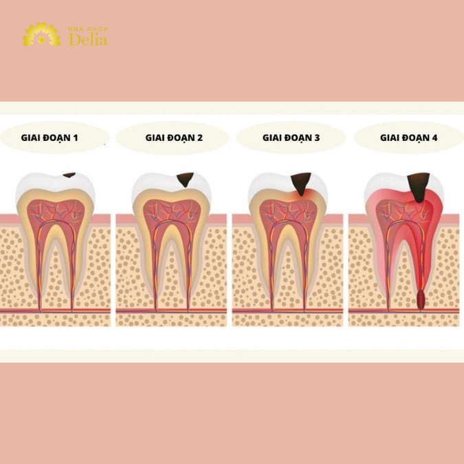 Các giai đoạn phát triển của sâu răng