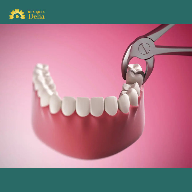 Răng số 8 bị sâu có nên nhổ không?