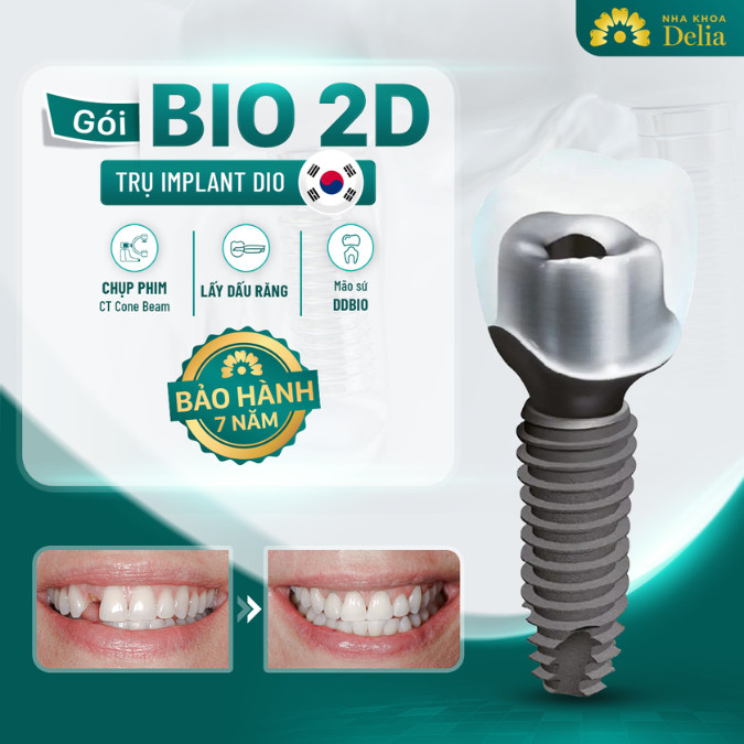 Trụ Implant Dio tại Nha khoa Delia được bảo hành 7 năm