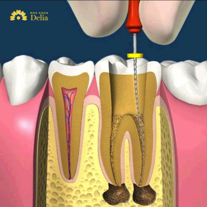 Điều trị sâu răng bằng phương pháp chữa tủy
