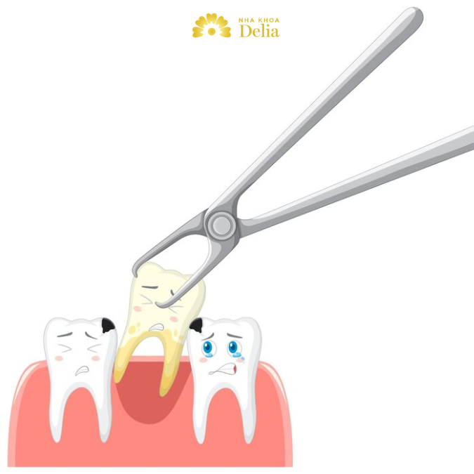 Sâu răng tình trạng nặng cần nhổ răng sâu và lắp răng giả