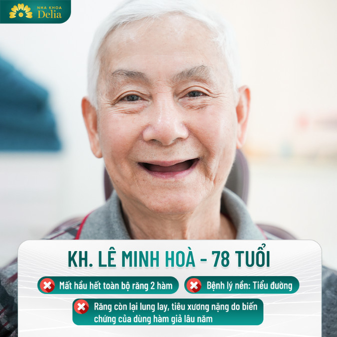 Giải đáp: Sử dụng hàm tháo lắp có trồng được Implant không?