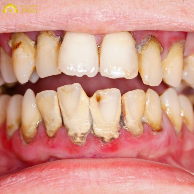 Nướu bị nhiễm trùng