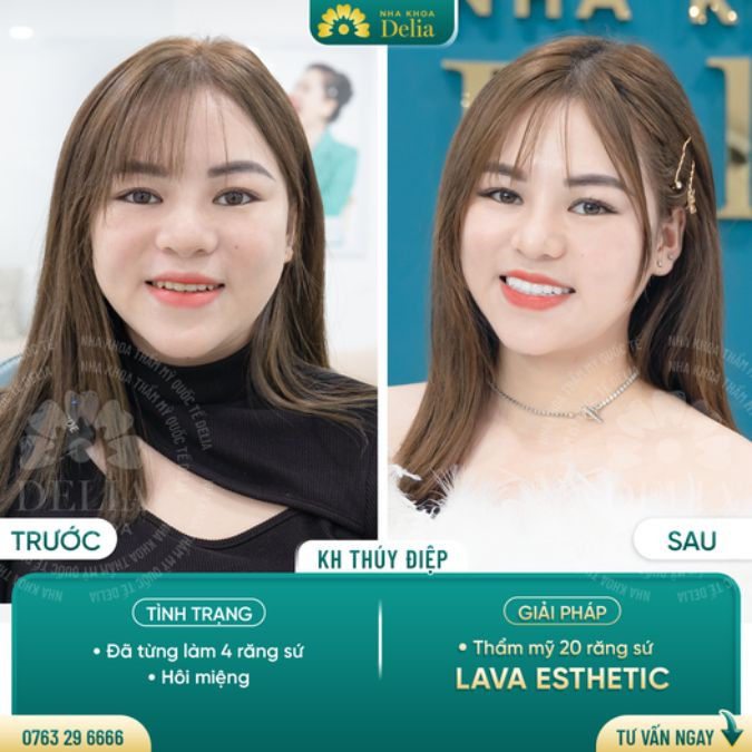 Trước khi đến nha khoa Delia, chị Điệp đã phải sống trong những ngày tháng biến chứng răng sứ hỏng