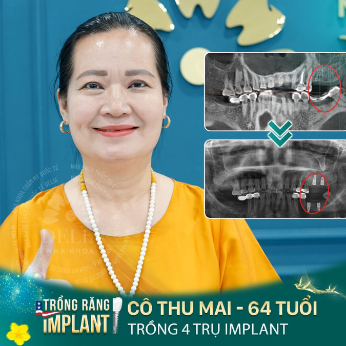 Giải đáp: Tiêu xương có trồng được Implant không?