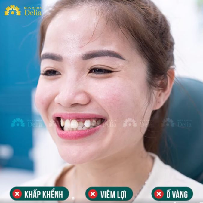 Chị Luyên đã trải qua nhiều tháng ngày sống chung với hàm răng viêm, khấp khểnh và ố vàng
