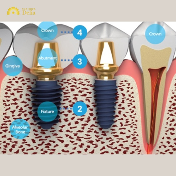 Thiết kế của trụ Megagen có ưu điểm gì trong cấy ghép Implant?