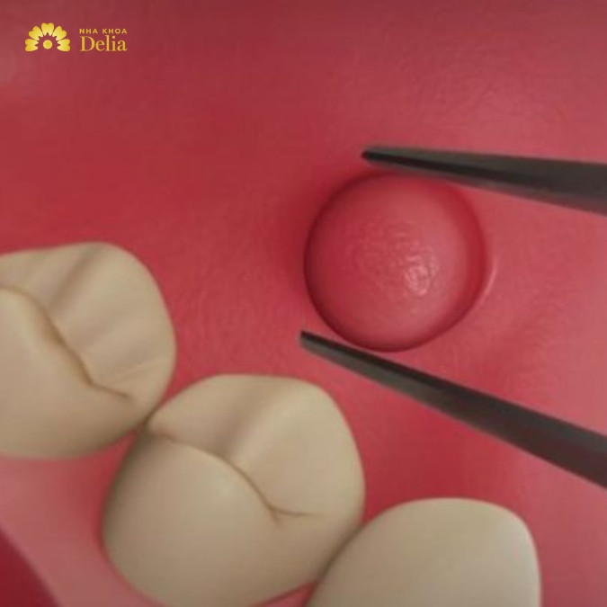 U xương răng thường diễn biến với các triệu chứng nào?