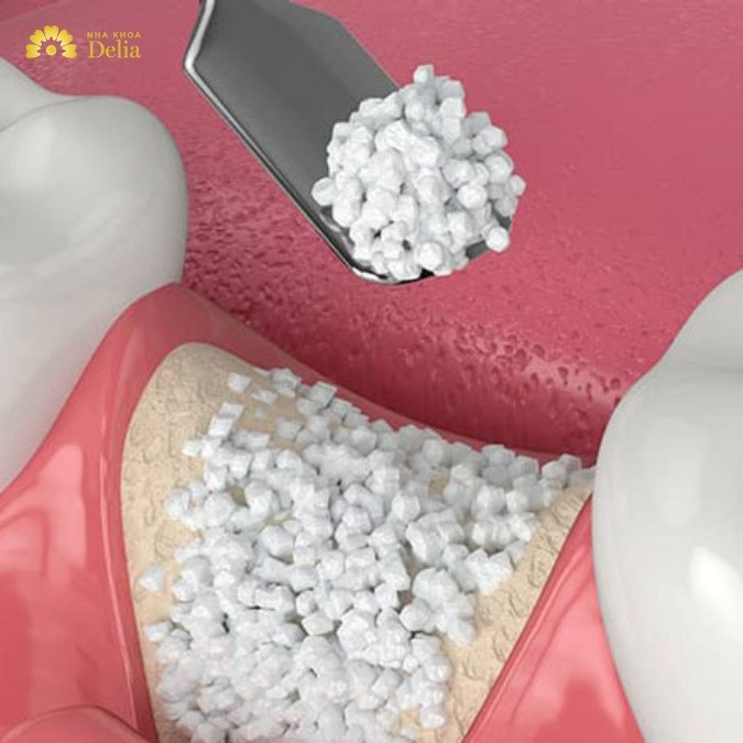 Ngăn chặn và điều trị tiêu xương ổ răng hiệu quả?