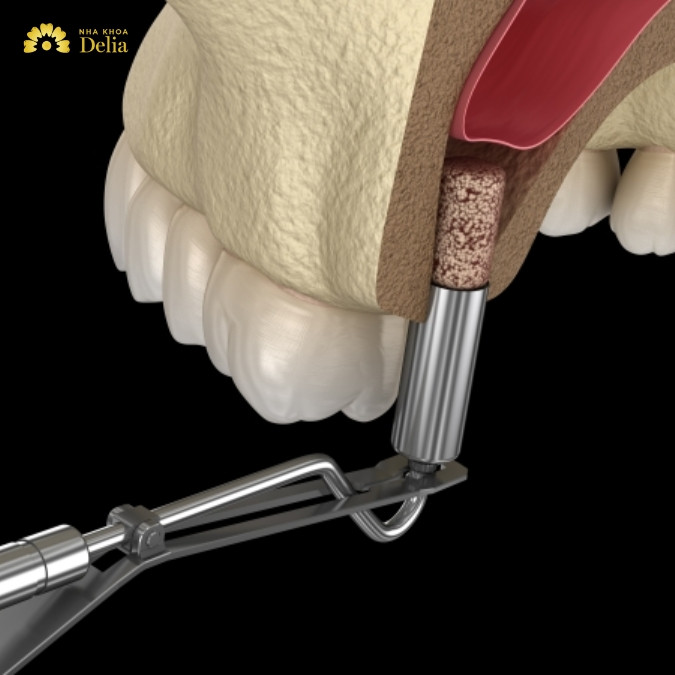 Ngăn chặn và điều trị tiêu xương ổ răng hiệu quả?