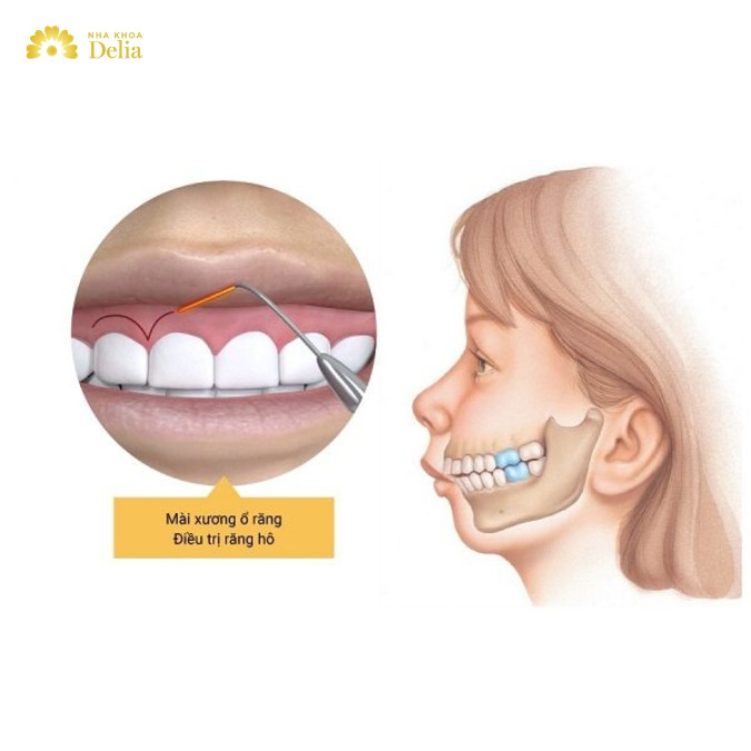 Tại sao phải giải phẫu xương ổ răng?