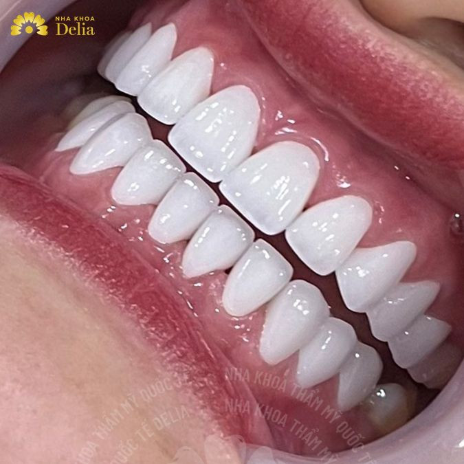 Đeo máng tẩy trắng răng tại nhà
