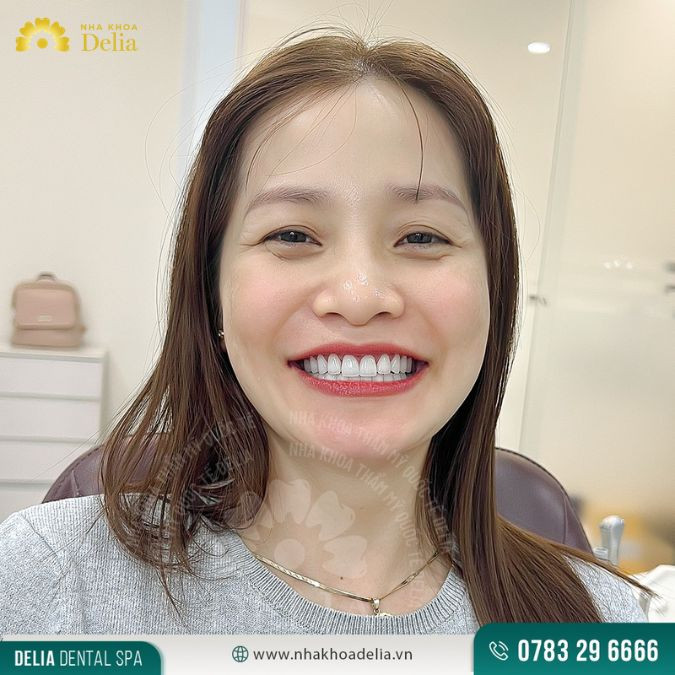 Tẩy trắng răng thông thường không đau