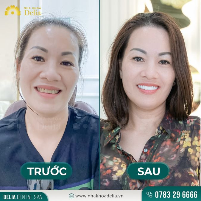 Đánh răng sai cách, các mảng bám không được làm sạch kỹ lưỡng