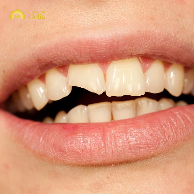 Khi nào cần trám răng: răng vỡ, mẻ